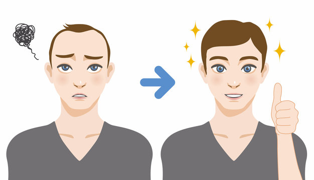 men's thinning hair treatment before after image illustration