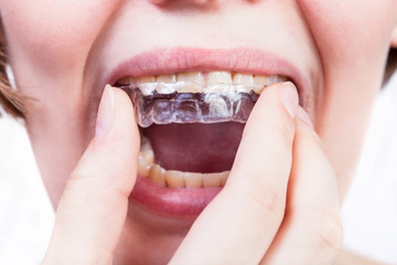 direct view of girl fixing clear aligner