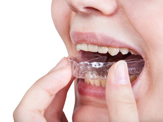 girl fixes aligner for orthodontic correction