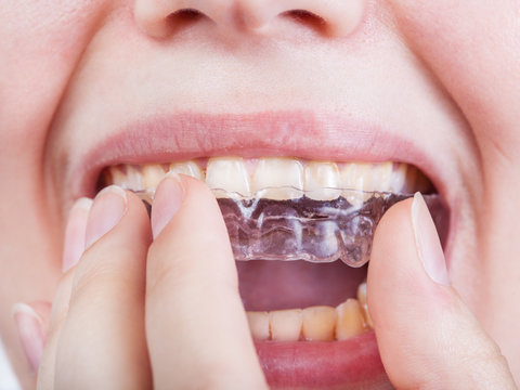 young woman puts clear aligner close up