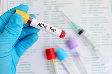 Blood sample for adrenocorticotropic hormone (ACTH) test
