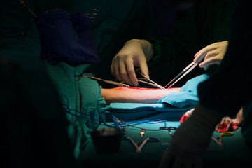 Surgery for Coronary Artery Bypass Grafting: CABG