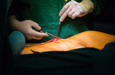 Surgery for Coronary Artery Bypass Grafting: CABG