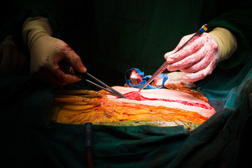 closure sternum bone with metal wires