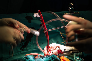 coronary artery bypass grafting