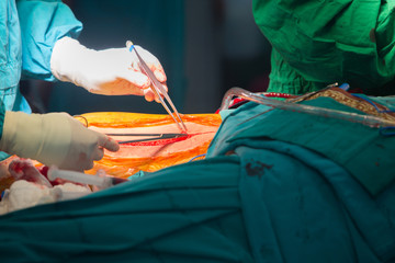 Surgery for Coronary Artery Bypass Grafting: CABG