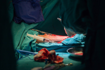 Surgery for Coronary Artery Bypass