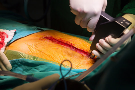 suture close sternotomy incision