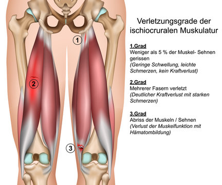 Ischiocrurale Muskeln des Oberschenkels, hamstring muscles