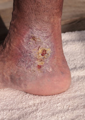 Medical picture: Infection cellulitis on the skin of an ankle caused by phlebitis and blood clots in the vein. 