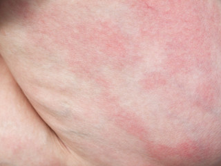 Rashes on the skin texture