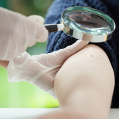 Dermatologist examining a mole