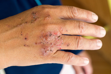 skin infection from ant bited