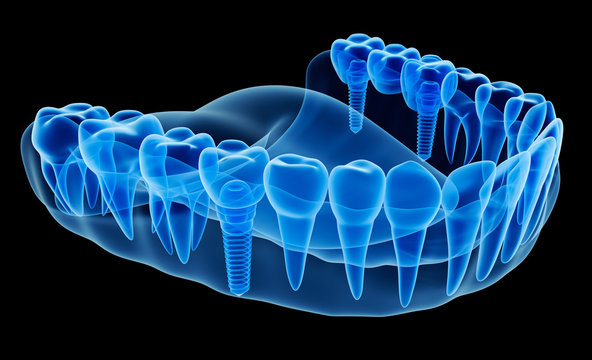 X-ray view of denture with implant