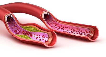 Blood vessel : normal and cholesterol damaged vessel . 3D render - obrazy, fototapety, plakaty