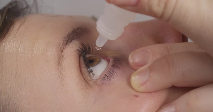 CLOSE UP: Woman drops an eyedrop into her eye