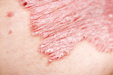 Fototapeta premium Psoriasis, psoriatic skin disease