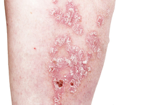 Psoriasis, psoriatic skin disease