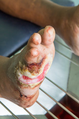 infected wound of diabetic foot