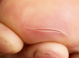 a cut on the finger skin
