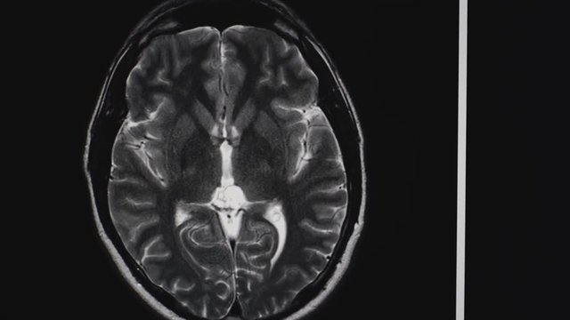 Doctor shows are problem zones in human brain MRI by pointer