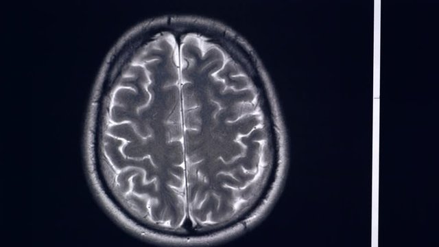 Doctor shows are problem zones in human brain MRI by pointer
