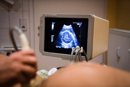 ultrasound image of a 30 week old fetus