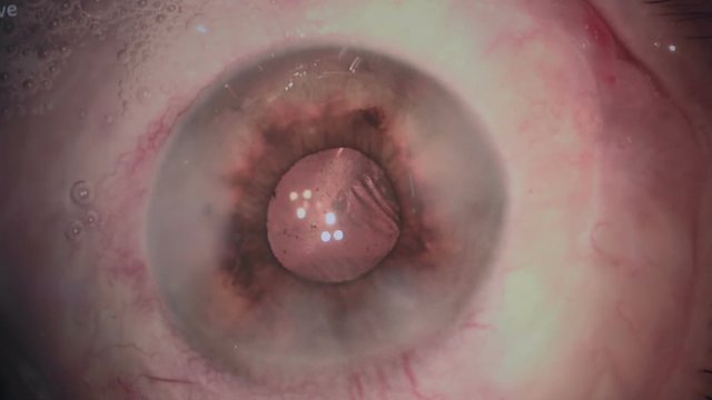 Eye surgery. Cataract removal surgery. Close up 1080p