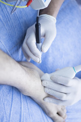 Obraz premium Intratissue percutaneous electrolysis