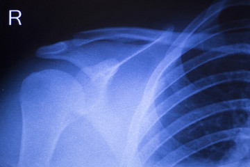 Shoulder joint orthopedic xray scan