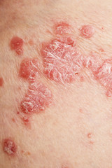 Fototapeta premium Psoriasis, psoriatic skin disease