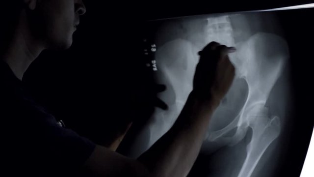 Doctor analyze x rays of hips bones. Doctor looking at x-rays of hips in illuminated panel.
