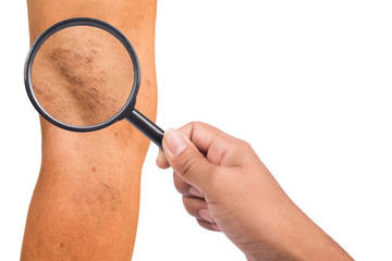 Varicose veins on the legs of middle-aged women
