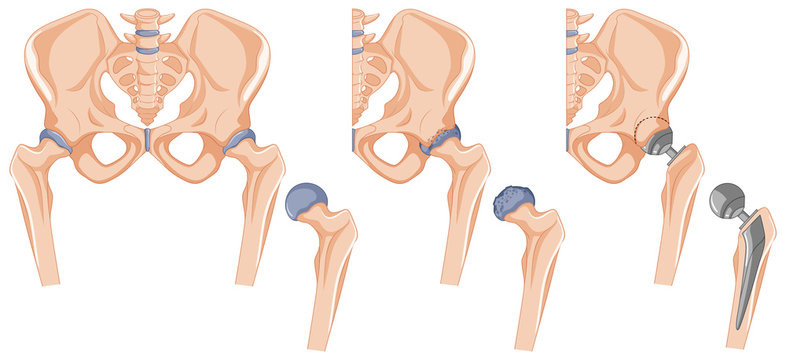 Diagram showing the hip bone treatment