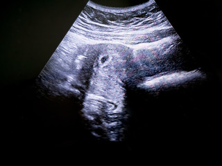 ultrasound of embryo at 5th weeks in pregnant woman
