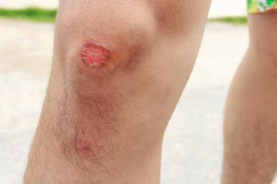 Bruise on right knee - Man knee pain