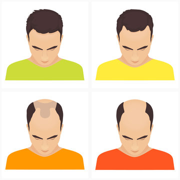 Different stages of hair loss in men. Hair care concept. Vector illustration.