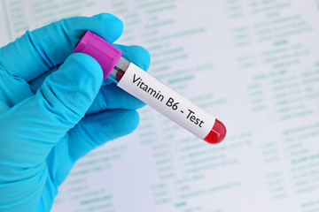 Fototapeta premium Test tube with blood sample for vitamin B6 test 