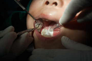 Dentists use dental instruments in the mouth of age children.