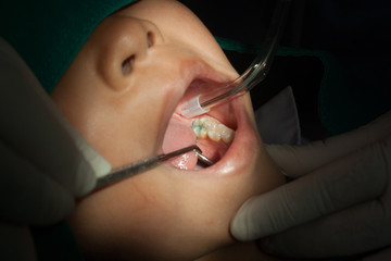 Dentists using the tool dental children, sealant.