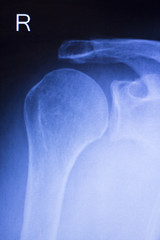 Shoulder joint orthopedic xray scan