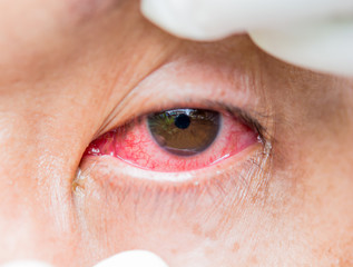 red bloodshot eye