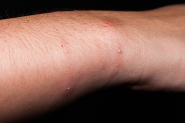 Dog bite wound and scar with grey background