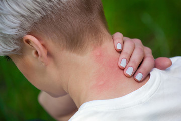 Girl with blond hair, sitting with his back turned and scratching bitten, red, swollen neck skin...
