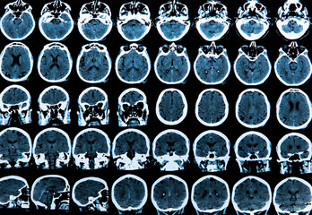 Mri Brain Scan