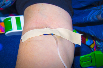 Intravenous infusion therapy on mature woman