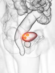3d rendered medically accurate illustration of bladder cancer