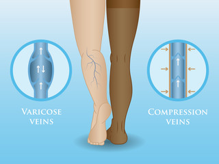Medical compression hosiery