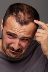 Obraz premium alopecia