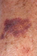 Fototapeta premium hematoma on the arm of an elderly woman